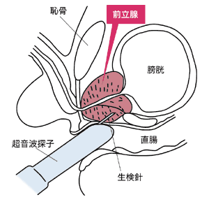 経直腸式前立線生検
