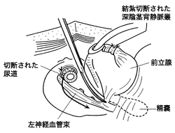 手術説明図