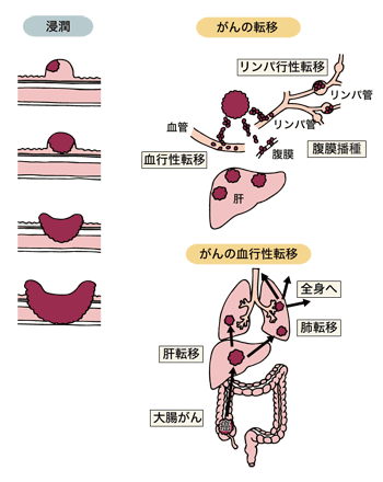 図:大腸がんの広がり方