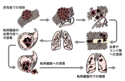 図:がんの転移(肺転移の成立)