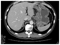 CTによる腹部断層画像