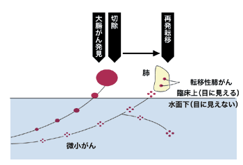図:大腸がんが肺に転移した場合