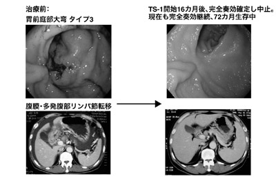 図:TS-1単剤による完全奏効例