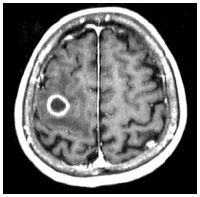 図：転移性脳腫瘍の原発巣となるがん種別の頻度