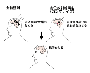 図:全脳照射と定位放射線照射